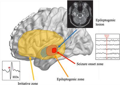 The network is more important than the node: stereo-EEG evidence of neurocognitive networks in epilepsy